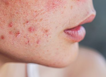 5. PCOS Skin Issues