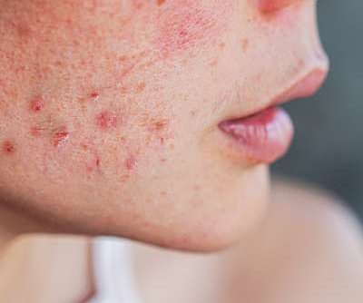5. PCOS Skin Issues
